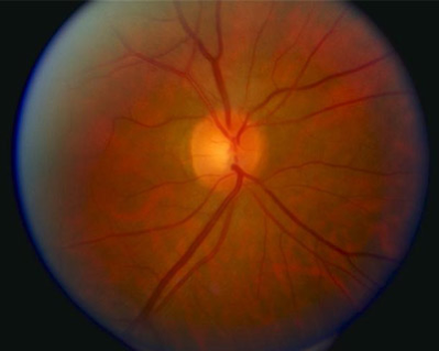 Normal optic disc and blood vessels as seen in a standard retina image.